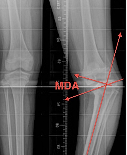 Blounts Metaphyseal Diaphyseal Angle